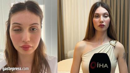 Zeytinburnu'nda botoks yaptıran kadının işlem sonrası göz kapağı düştü!