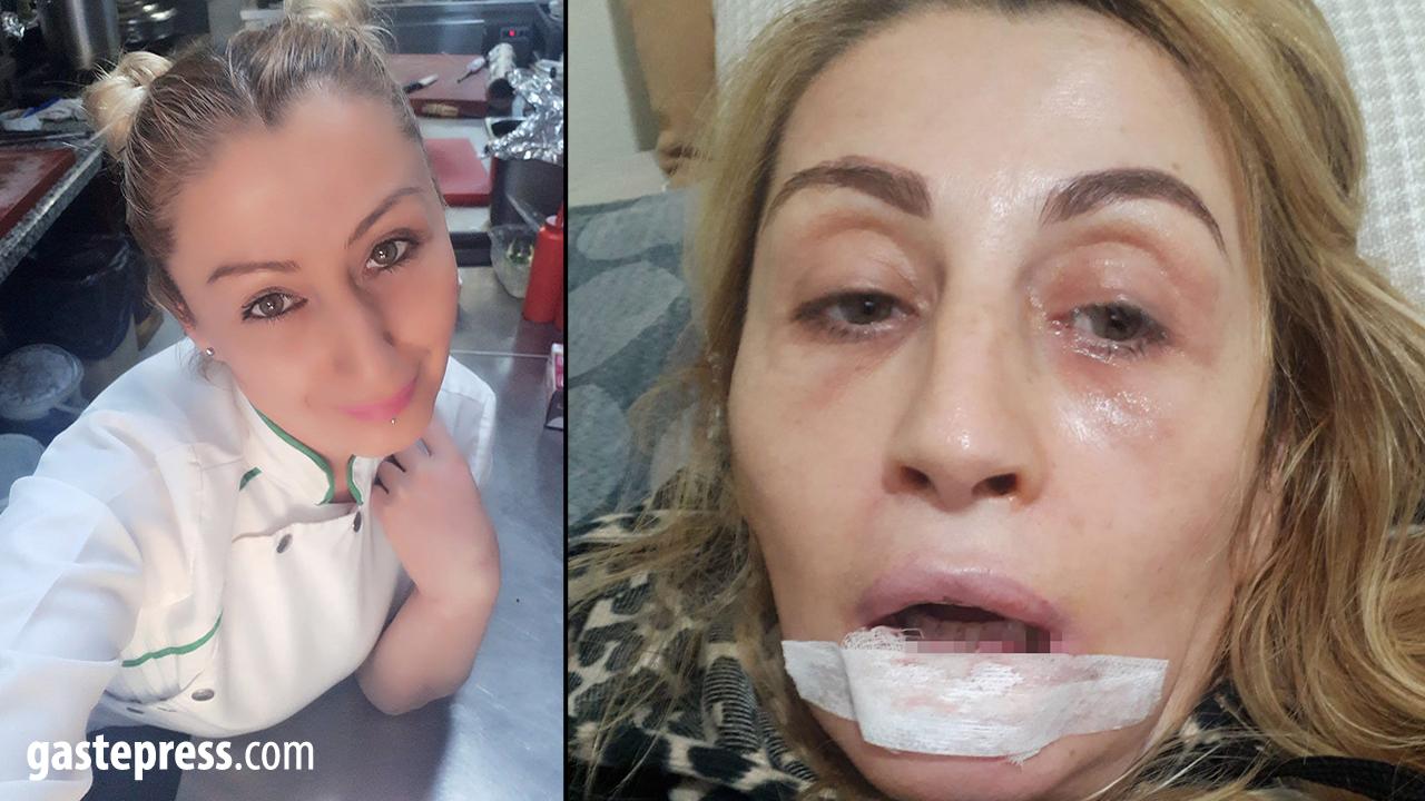 Estetik İşlem Sonrası Dudağında Doku Kaybı Oluştu! 7 Yıllık Hukuk Mücadelesi Sürüyor!